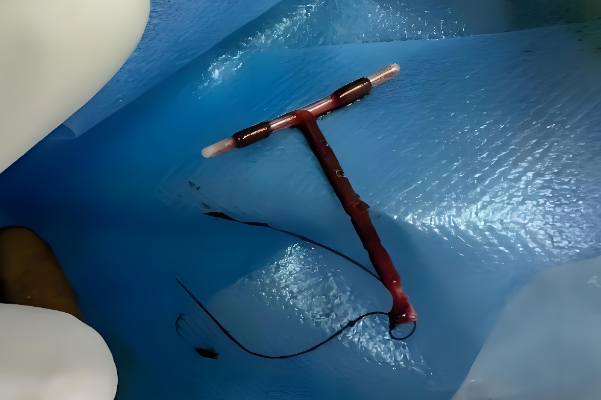 为什么现在医院医生都推荐没有生育计划的女性上爱母环？